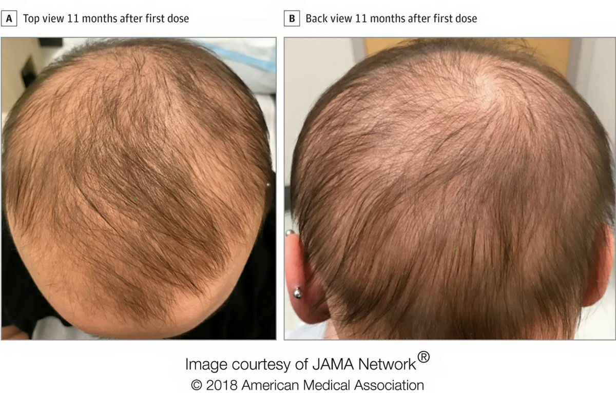 O efeito colateral de um remdio para eczema devolveu o cabelo a uma paciente careca