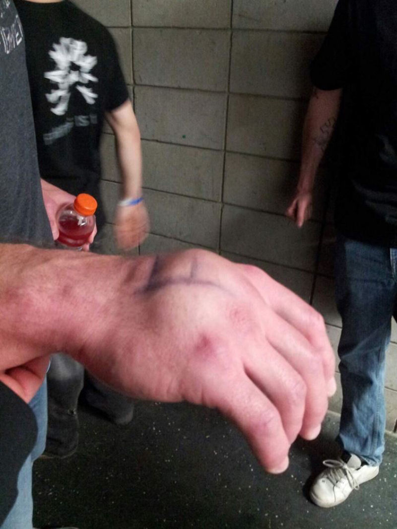 Assim pode ficar a mão de um boxeador após um nocaute.