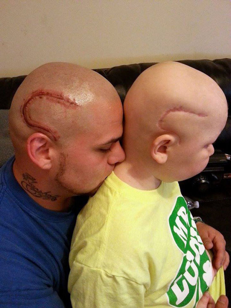 Josh Marshall tatua couro cabeludo imitando cicatriz da cirurgia de seu filho para inspirar auto-confiança.