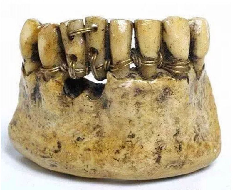 Assim eram colocadas as próteses dentais no passado.