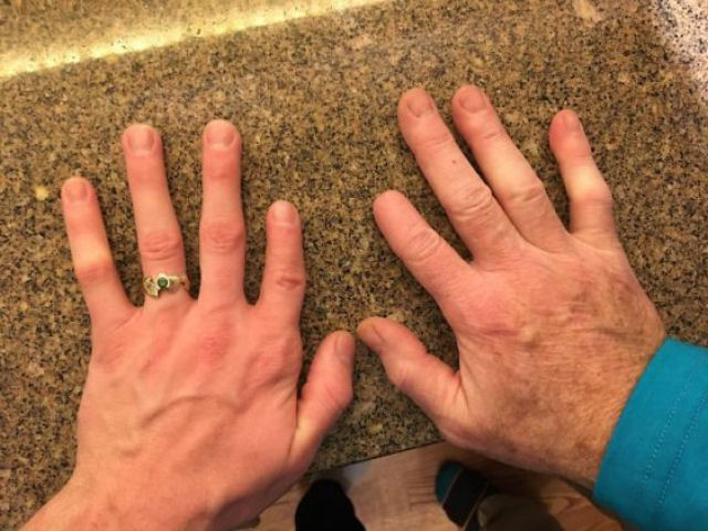 A mão direita corresponde ao pai que cortou o dedo quando tinha 10 anos. A mão da esquerda é do filho, cujo dedo curiosamente é mais curto que o normal.