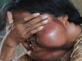 Incrível transformação da mãe chinesa, desfigurada pelo cordoma, depois da cirurgia