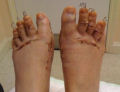 Cirurgia Cinderela: um procedimento bizarro de encurtamento dos dedos dos pés