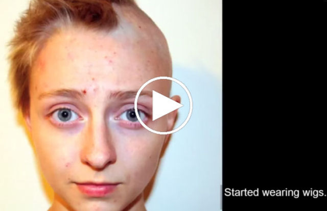 Um video mostra 6,5 anos de luta de uma garota que arranca seu próprio cabelo