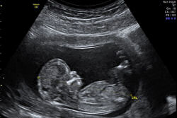 Feminista decide abortar só porque seu futuro filho seria homem