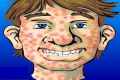 Encontram a cura para a acne
