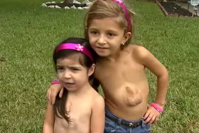 Estas duas meninas, que nasceram com o coração fora do corpo, queriam se conhecer