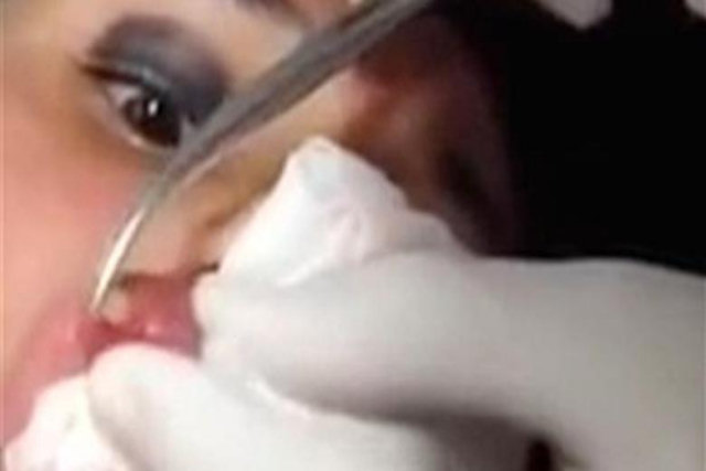 Argh... Eca! Médico retira larva dos lábios de uma garota