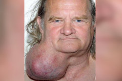 Homem resistiu 25 anos a retirar um enorme tumor do pescoço
