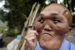 Chinês com severas deformidades faciais nessescita de cirurgia