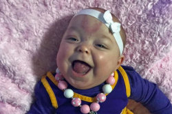 Recém-nascida com língua enorme sorri pela primeira vez após a cirurgia de redução