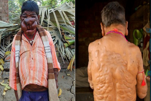 Menino indiano não tem convívio social devido a tumores que não param de crescer em seu rosto e corpo