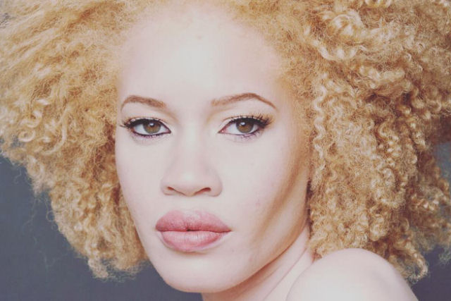 Modelo com albinismo desafia as percepções de beleza na indústria da moda