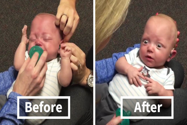 Bebê ouve a mãe pela primeira vez após implante auditivo e sua reação derreterá seu coração
