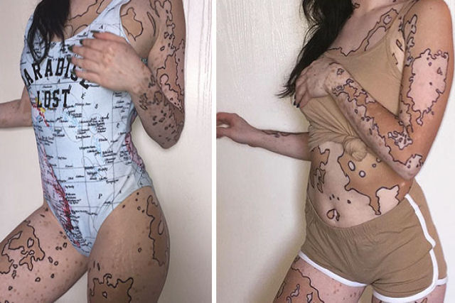Jovem com vitiligo usa seu corpo como tela para obras artísticas surpreendentes