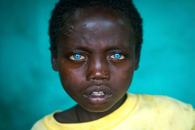 Este menino tem uma doença genética rara que faz com que seus olhos sejam fascinantes
