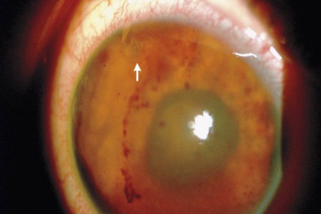 Encontram um verme perfurando o olho de um jovem mexicano que foi ao médico se queixando de problemas de visão