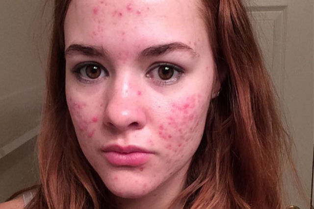 O incrível antes e depois desta jovem com acne severa