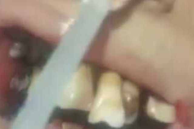 Dentista abre a boca do paciente e descobre vermes vivos entre os dentes