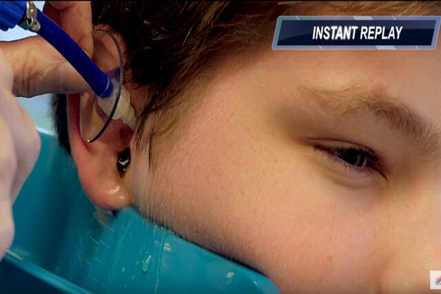 Médico remove grande quantidade de cerume do ouvido de um garoto