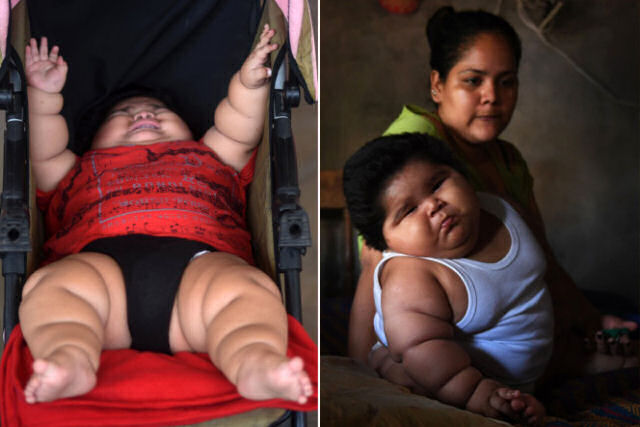 O drama de Luisinho, o bebê de 10 meses que pesa 30 quilos