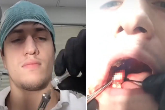 Dentista russo extrai seu próprio dente do siso