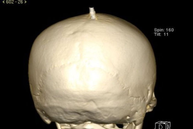 Um milímetro de sorte: o caso do menino que sobreviveu após um parafuso perfurar seu crânio