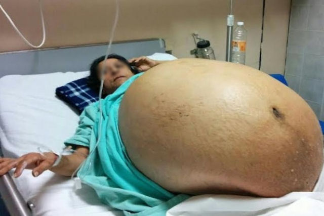 Extirpam um tumor de 60 quilos do ovrio de uma mulher