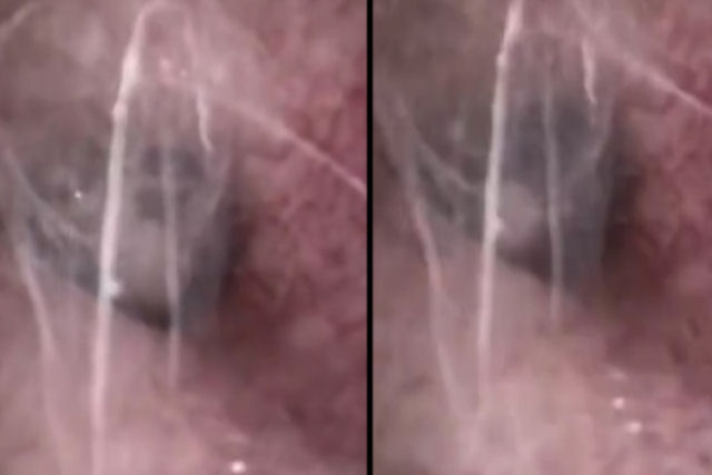 Mdicos chineses chocados ao encontrar teias de aranha dentro do ouvido de um homem