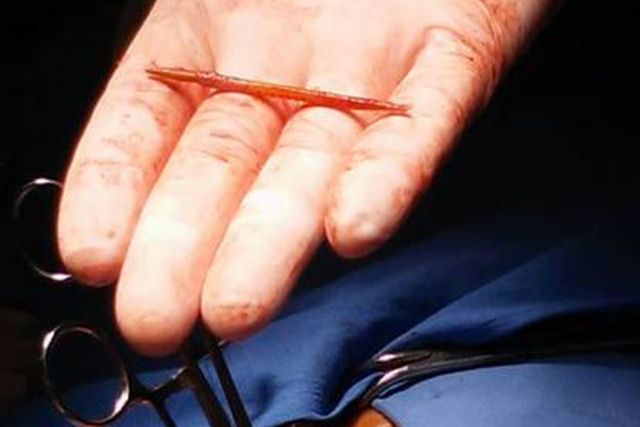 Mdicos removem um palitinho do corao que chins engoliu enquanto bebia