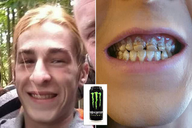 Jovem britnico perde os dentes depois de tomar 6 latinhas dirias de energtico durante meses