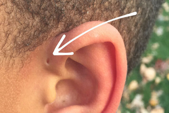 Por que algumas pessoas têm um pequeno furo extra na orelha?