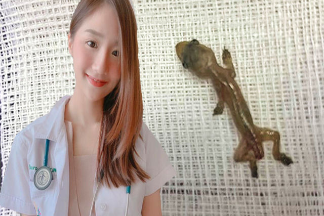 Mdica tailandesa encontra uma lagartixa viva no ouvido do paciente