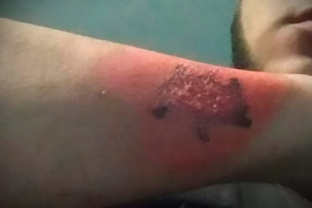 Argentino usa ralador de queijo para remover tatuagem uma semana depois de faz-la