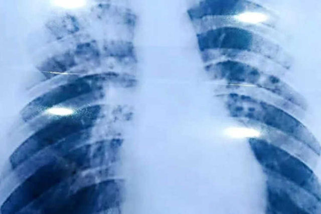 Professor mongol comprou diagnstico falso de tuberculose on-line para que pudesse tirar frias mais longas