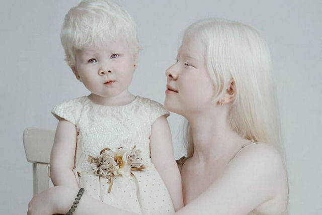 A beleza surpreendente de irmãs albinas nascidas com 12 anos de diferença