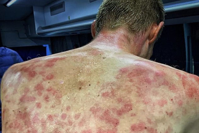 Ciclista belga mostra hematomas horríveis nas costas após chuva de granizo