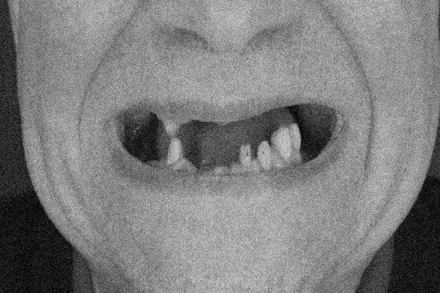 A pavorosa histria do psiquiatra que tentou 'curar' seus pacientes arrancando seus dentes<br />
