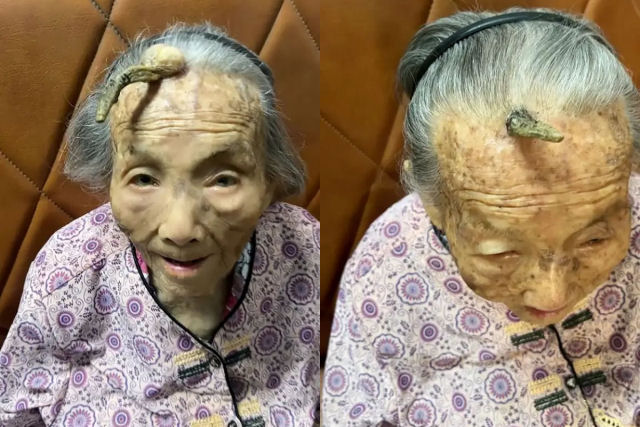 Chinesa de 107 anos tem um grande chifre crescendo na testa