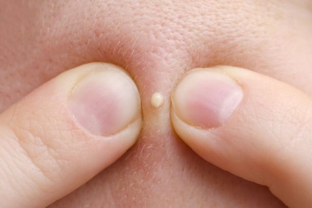 Existe cura para as espinhas?