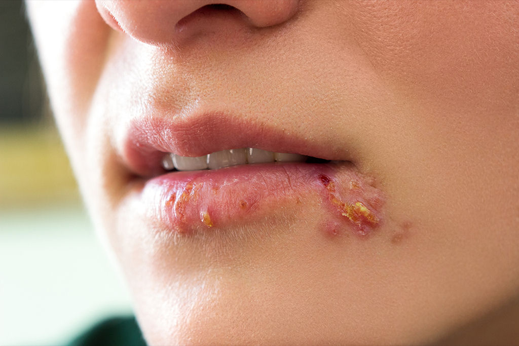 O que diabos causa o herpes e como � poss�vel trat�-lo?