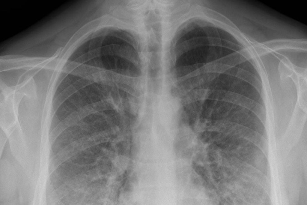 Como a perigosa pneumonia se instala no corpo humano?
