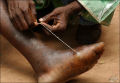 O verme da Guiné, um parasita fora do comum